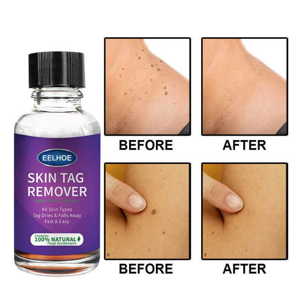 Foreign Trade Cross-Border Eelhoe Skin Verrucous Remover To Solve Skin Verrucous Hanzuva