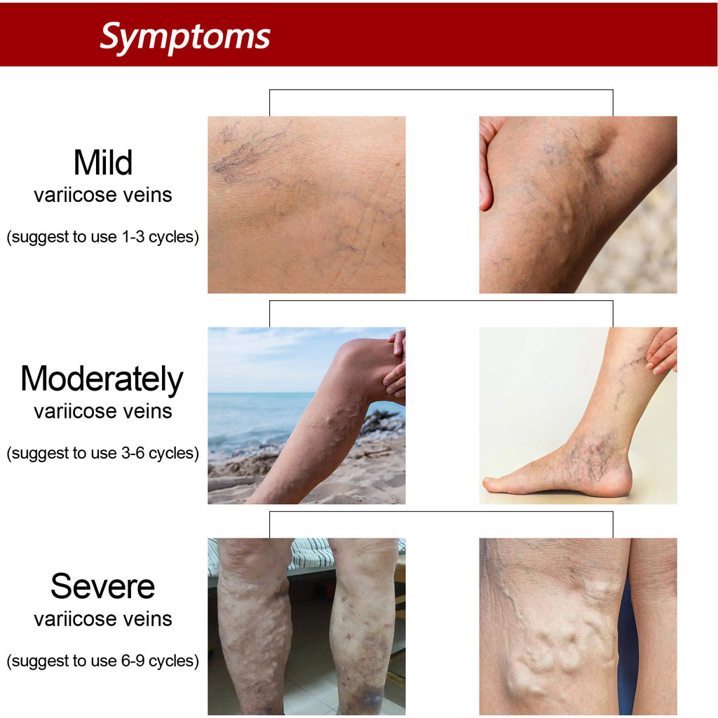 Earthworm Leg Vein Massage Cream For Relieving Leg Vascular Protrusion And Leg Swelling