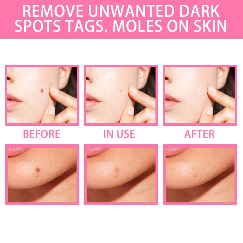 Organic Tags Solutions Serum No Trace Painle Skin Tag Remover Serum Mole Removal Cream Painless Face Wart Mole Freckle